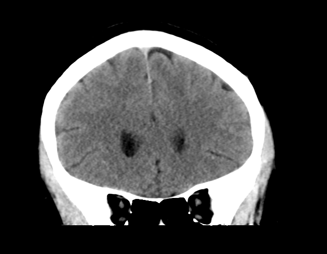 File:Acoustic schwannoma (Radiopaedia 33045-34065 Coronal non-contrast 16).png