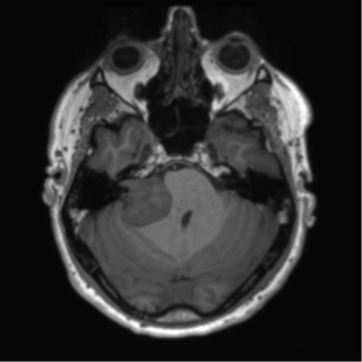 File:Acoustic schwannoma (Radiopaedia 50846-56358 Axial T1 25).png