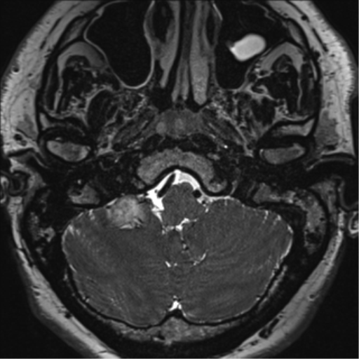 File:Acoustic schwannoma (Radiopaedia 50846-56358 Axial T2 6).png