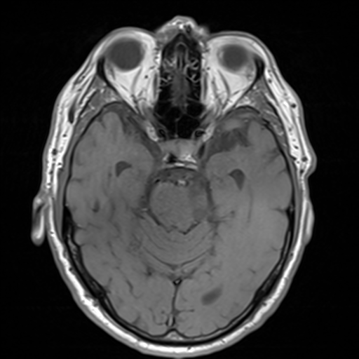File:Acoustic schwannoma (Radiopaedia 55729-62281 T1 12).png