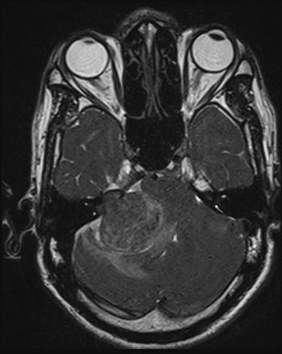 File:Acoustic schwannoma - probable (Radiopaedia 20386-20292 Axial T1 42).jpg