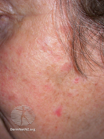 Actinic Keratoses affecting the face (DermNet NZ lesions-ak-face-374).jpg