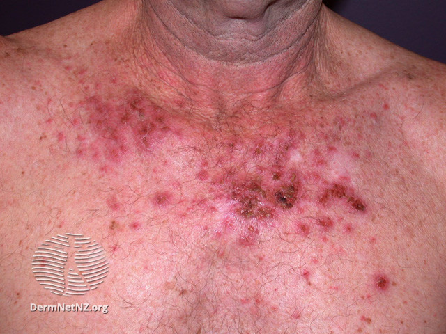 Actinic Keratoses treated with imiquimod (DermNet NZ lesions-ak-imiquimod-3748).jpg