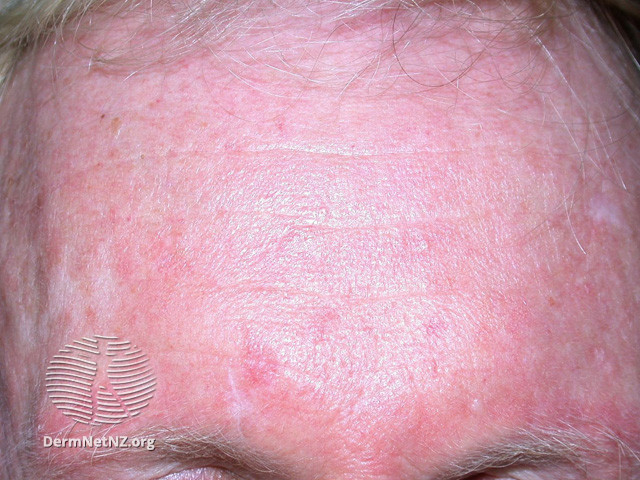 Actinic Keratoses treated with imiquimod (DermNet NZ lesions-ak-imiquimod-3755).jpg