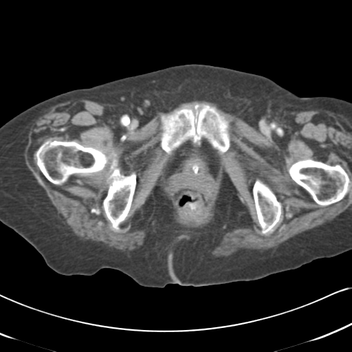 Active bleeding from duodenal ulcer with embolization (Radiopaedia 34216-35481 C 69).png