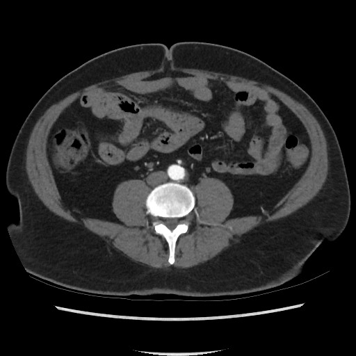 Active colonic bleed on CT (Radiopaedia 49765-55025 Axial C+ arterial phase 49).jpg