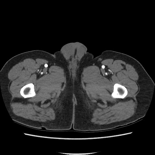 File:Active colonic bleed on CT (Radiopaedia 49765-55025 Axial C+ arterial phase 94).jpg