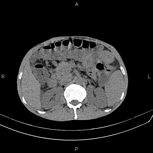 Active crohn disease (Radiopaedia 87133-103397 Axial non-contrast 34).jpg