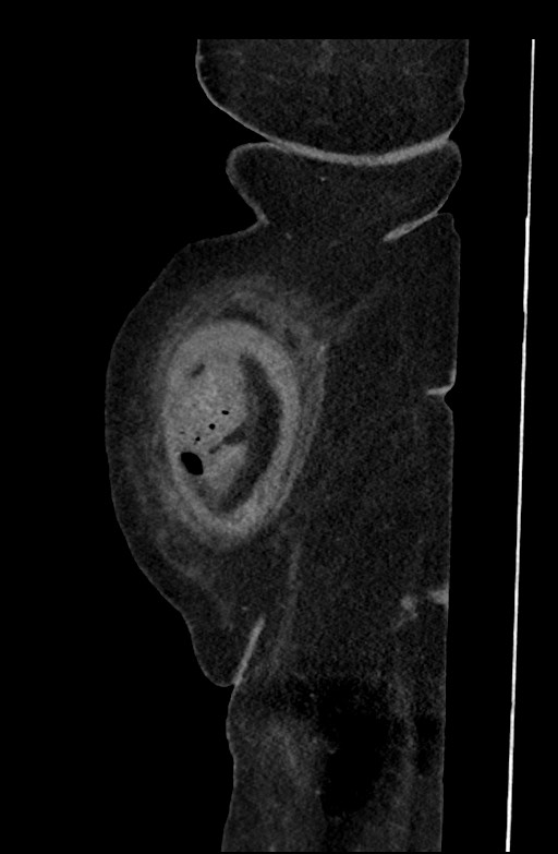 Active renal extravasation with large subcapsular and retroperitoneal hemorrhage (Radiopaedia 60975-68796 Sagittal C+ portal venous phase 202).jpg