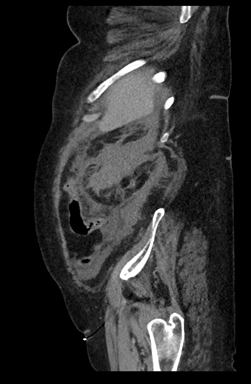 Active renal extravasation with large subcapsular and retroperitoneal hemorrhage (Radiopaedia 60975-68796 Sagittal C+ portal venous phase 56).jpg