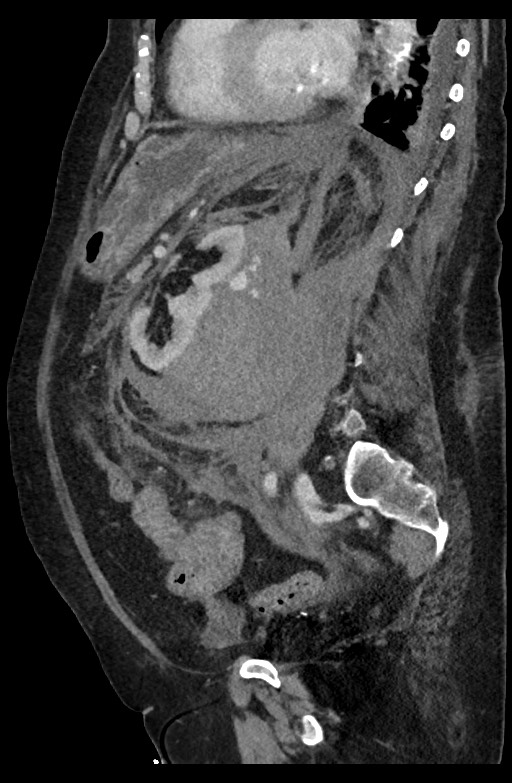 Active renal extravasation with large subcapsular and retroperitoneal hemorrhage (Radiopaedia 60975-68796 Sagittal C+ portal venous phase 96).jpg