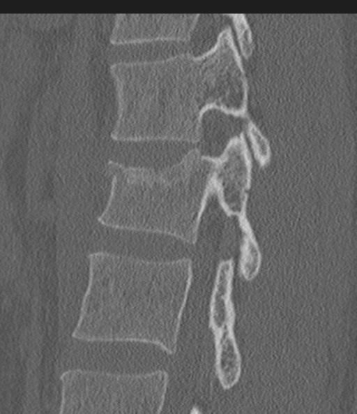 File:Acute L1 burst compression fracture (Radiopaedia 34430-35755 Sagittal bone window 41).png