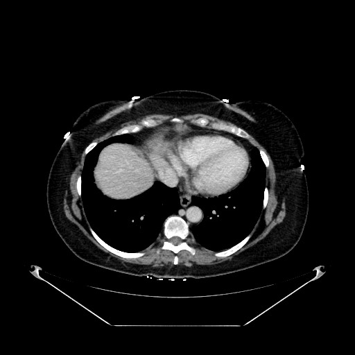 Acute appendicitis, heterotaxy syndrome (Radiopaedia 66884-76202 Axial C+ portal venous phase 13).jpg