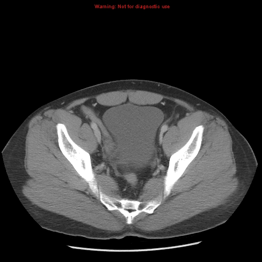 Acute appendicitis (Radiopaedia 10498-10973 Axial C+ portal venous phase 46).jpg