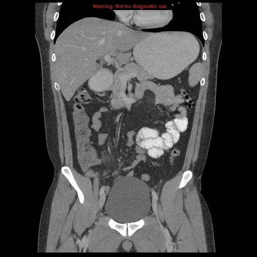 File:Acute appendicitis (Radiopaedia 10498-10973 F 12).jpg