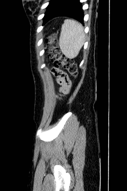 Acute appendicitis (Radiopaedia 22892-22918 Sagittal C+ portal venous phase 78).png