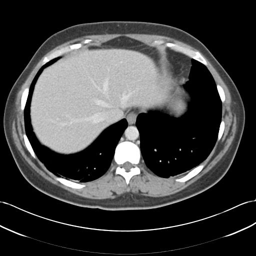 File:Acute appendicitis (Radiopaedia 30297-30934 Axial C+ portal venous phase 10).jpg