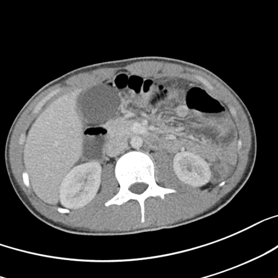 Acute appendicitis (Radiopaedia 32614-33572 Axial C+ portal venous phase 25).jpg