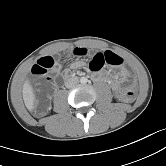 Acute appendicitis (Radiopaedia 32614-33572 Axial C+ portal venous phase 34).jpg