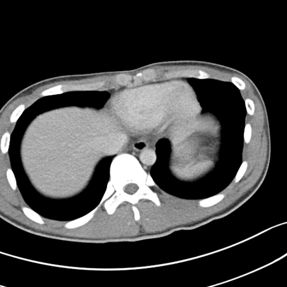 File:Acute appendicitis (Radiopaedia 32614-33572 Axial C+ portal venous phase 4).jpg