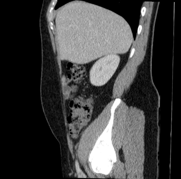 Acute appendicitis (Radiopaedia 38255-40270 Sagittal C+ portal venous phase 21).jpg