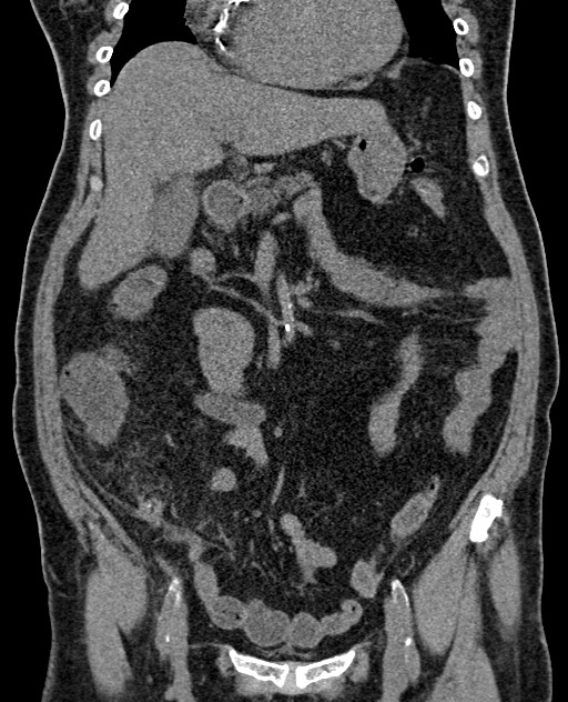 Acute appendicitis (Radiopaedia 58627-65818 Coronal non-contrast 34).jpg