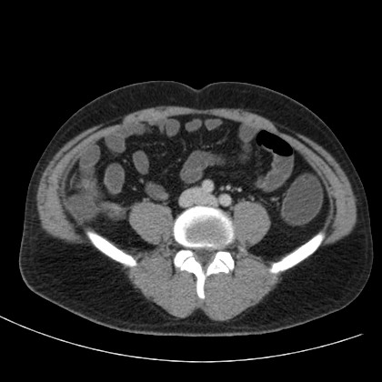 Acute appendicitis (Radiopaedia 66513-75790 Axial C+ portal venous phase 54).jpg