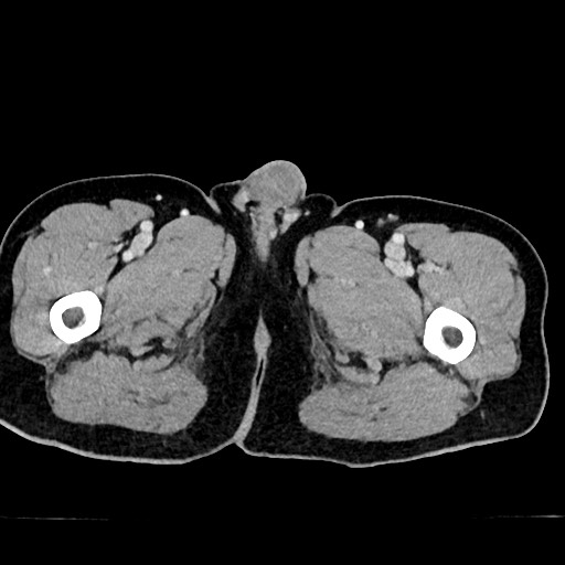 Acute appendicitis (Radiopaedia 77016-88960 Axial C+ portal venous phase 164).jpg