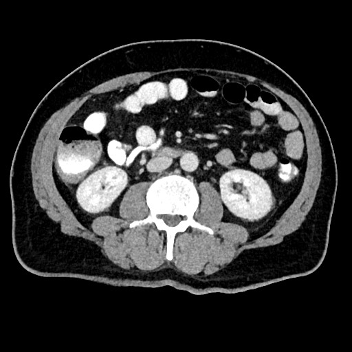Acute appendicitis (Radiopaedia 77016-88960 Axial C+ portal venous phase 71).jpg