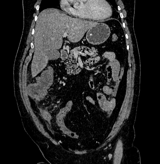 Acute appendicitis (Radiopaedia 79950-93224 Coronal C+ portal venous phase 33).jpg