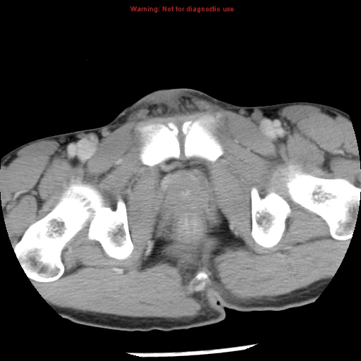 Acute appendicitis (Radiopaedia 8195-9045 Axial C+ portal venous phase 77).jpg