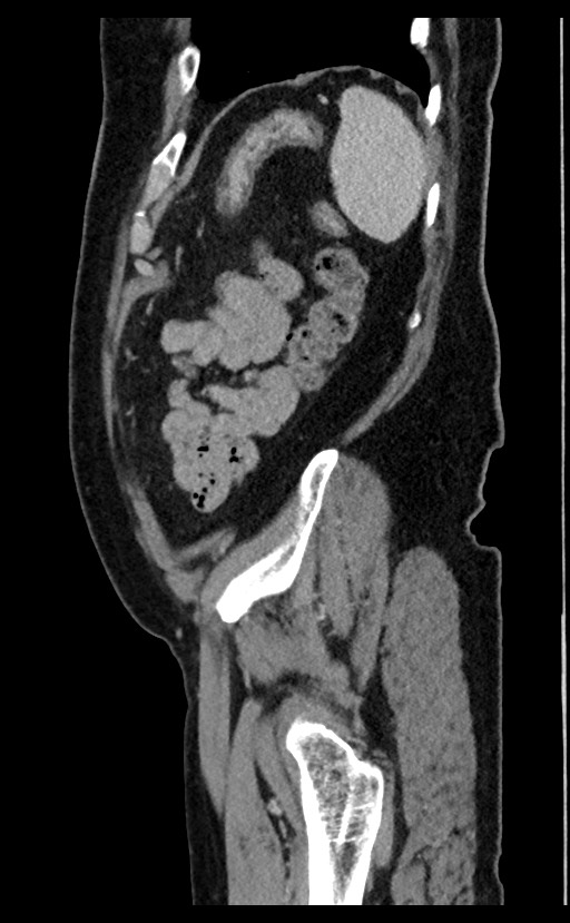 Acute appendicitis - large appendicoliths (Radiopaedia 61805-69820 Sagittal C+ portal venous phase 17).jpg
