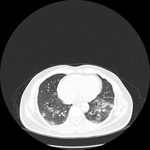 Acute appendicitis and COVID 19 pneumonia (Radiopaedia 76604-88380 Axial lung window 37).jpg