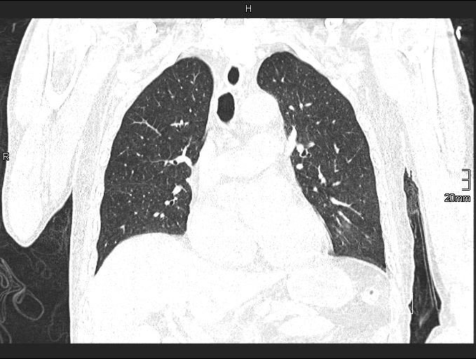 Acute aspiration pneumonitis (Radiopaedia 55642-62166 Coronal lung window 45).jpg