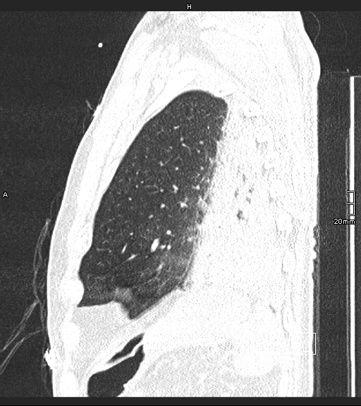 Acute aspiration pneumonitis (Radiopaedia 55642-62166 Sagittal lung window 21).jpg