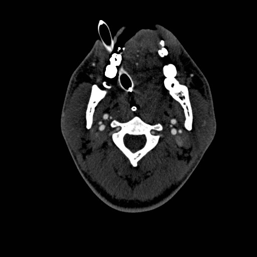 Acute basilar artery occlusion (Radiopaedia 43582-46985 Axial C+ arterial phase 141).jpg