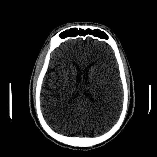 Acute basilar artery occlusion (Radiopaedia 43582-46985 Axial non-contrast 107).jpg