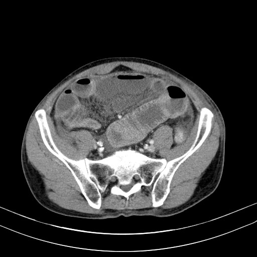 Acute bowel ischemia (Radiopaedia 87695-104114 Axial C+ portal venous phase 64).jpg