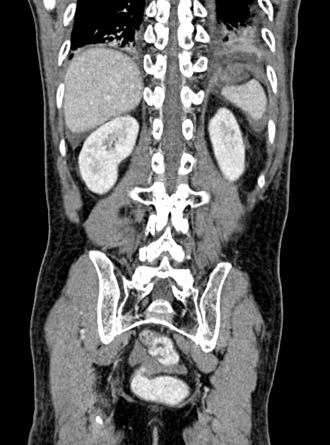 Acute bowel ischemia (Radiopaedia 87695-104114 Coronal C+ portal venous phase 295).jpg