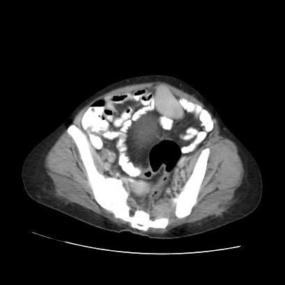 File:Acute calculous cholecystitis in patient with osteopetrosis (Radiopaedia 77871-90159 Axial C+ portal venous phase 65).jpg