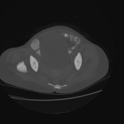 File:Acute calculous cholecystitis in patient with osteopetrosis (Radiopaedia 77871-90159 Axial bone window 44).jpg