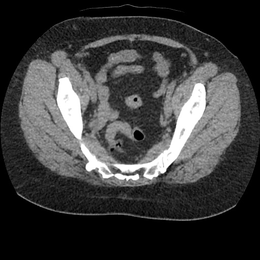 Acute cholecystitis and ureteric colic (Radiopaedia 42330-45444 Axial prone 92).jpg