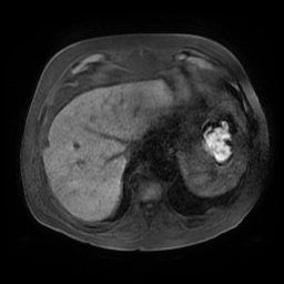 Acute cholecystitis complicated by pylephlebitis (Radiopaedia 65782-74915 Axial T1 fat sat 14).jpg