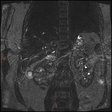File:Acute cholecystitis with gallbladder neck calculus (Radiopaedia 42795-45971 Coronal Turbo spin echo 4).jpg