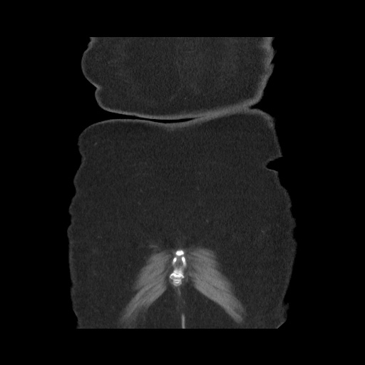 Acute cholecystitis with tensile fundus sign (Radiopaedia 71394-81723 Coronal non-contrast 119).jpg