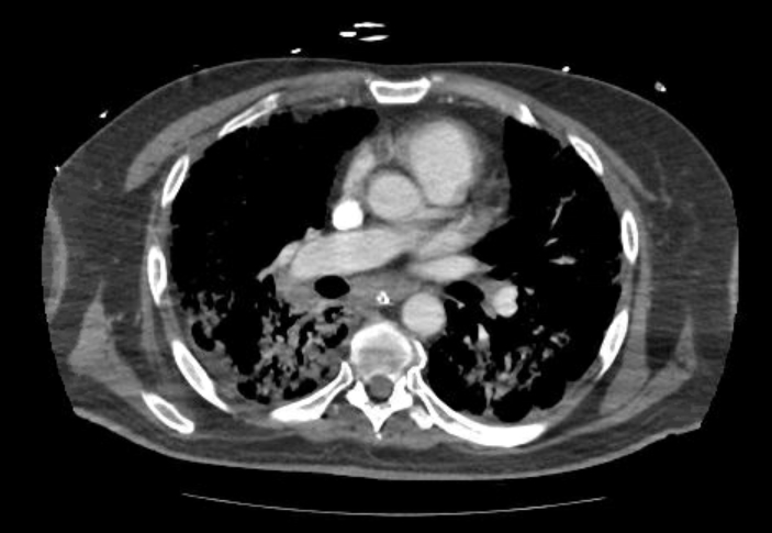 Acute cor pulmonale (ultrasound) (Radiopaedia 83508-98818 Axial C+ CTPA 38).jpg