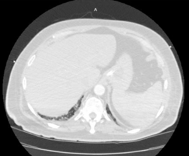 Acute cor pulmonale (ultrasound) (Radiopaedia 83508-98818 Axial lung window 84).jpg