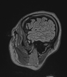 Acute disseminated encephalomyelitis (ADEM)- Anti-NMDA receptor encephalitis (Radiopaedia 54920-61201 Sagittal FLAIR 18).png