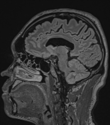 Acute disseminated encephalomyelitis (ADEM)- Anti-NMDA receptor encephalitis (Radiopaedia 54920-61201 Sagittal FLAIR 49).png