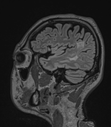 Acute disseminated encephalomyelitis (ADEM)- Anti-NMDA receptor encephalitis (Radiopaedia 54920-61201 Sagittal FLAIR 64).png